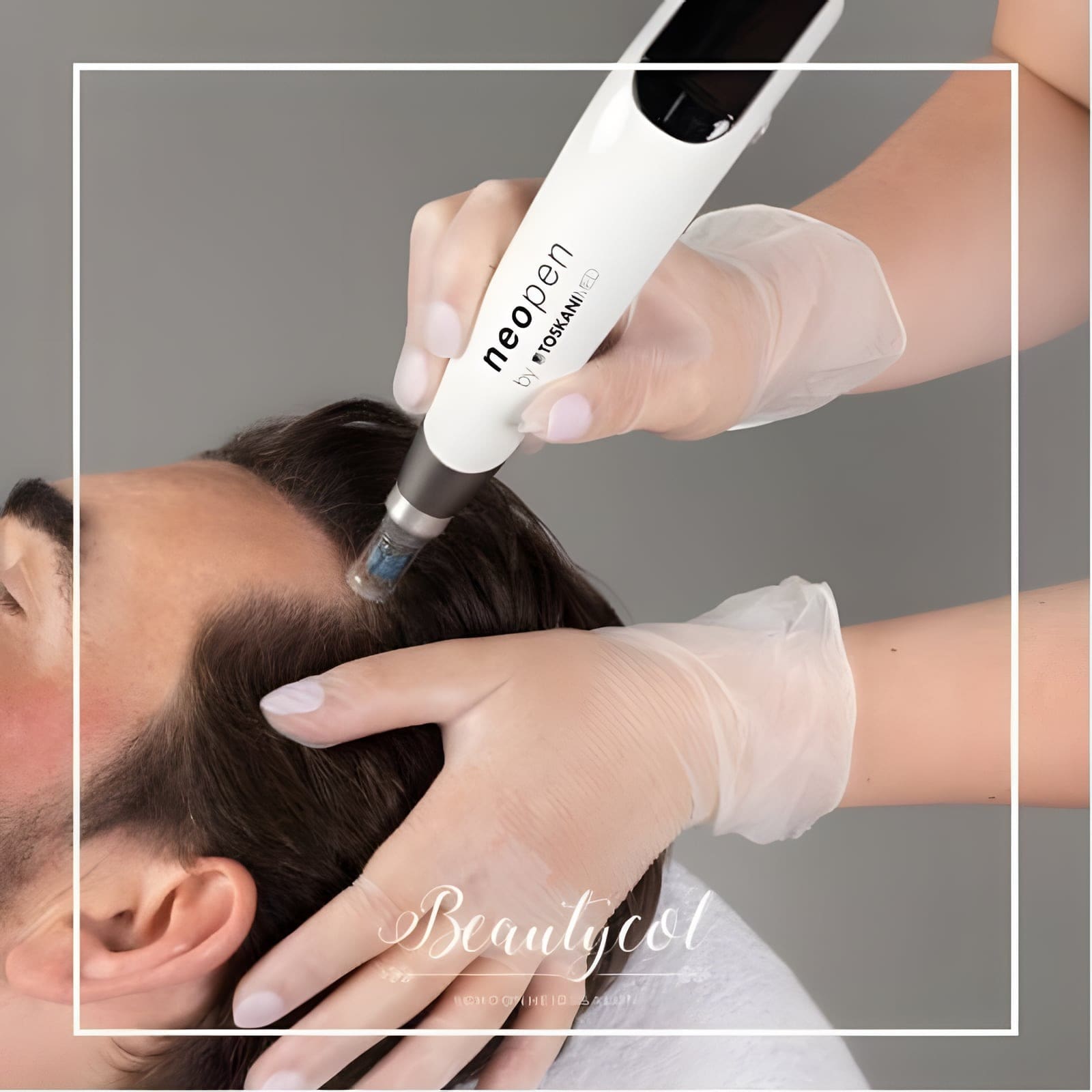 Hair Grow behandeling van de hoofdhuid met de Neopen bij Beautycol