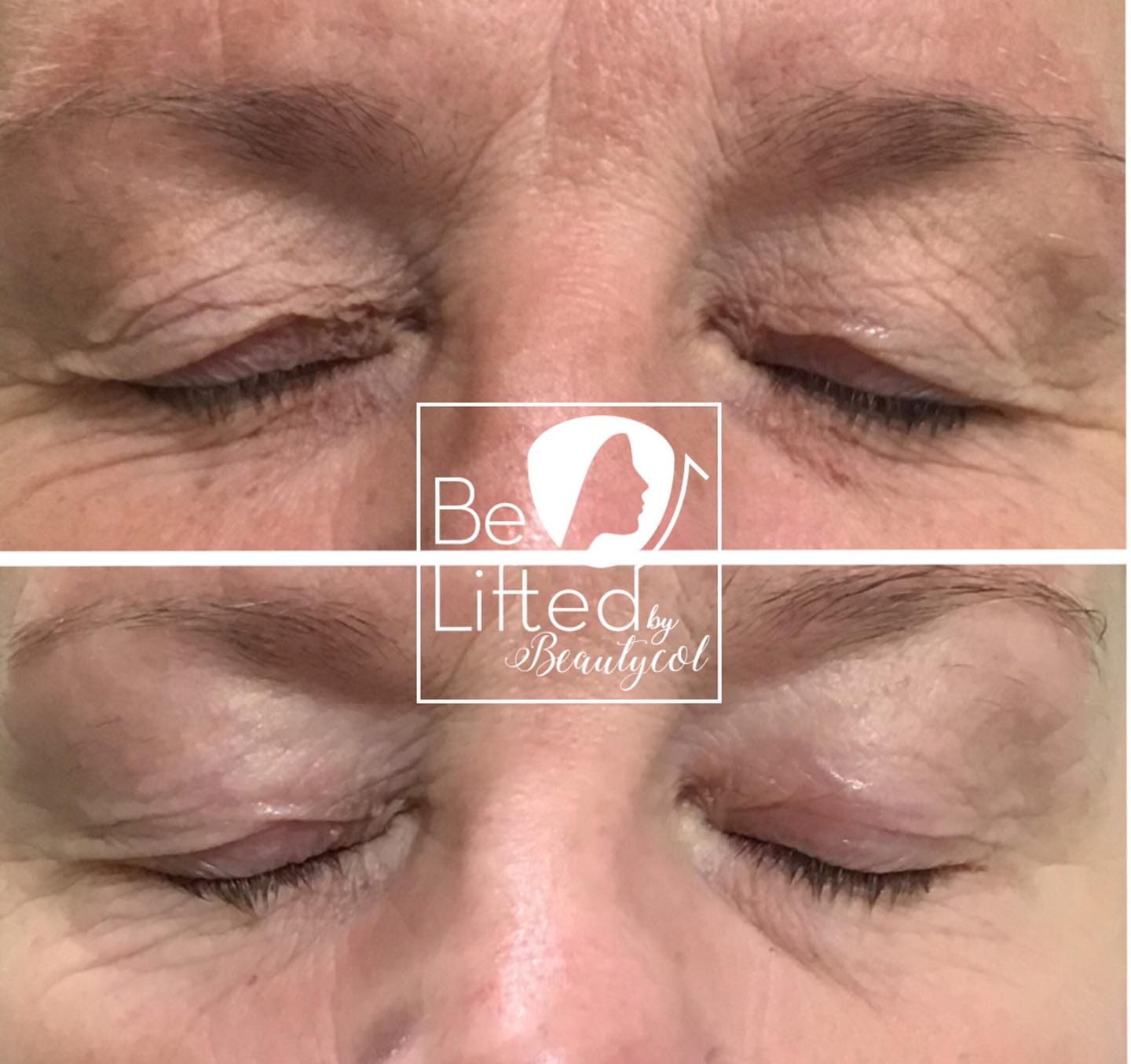 Bovenoogleden voor en na een Be Lifted Plasma behandeling bij Beautycol